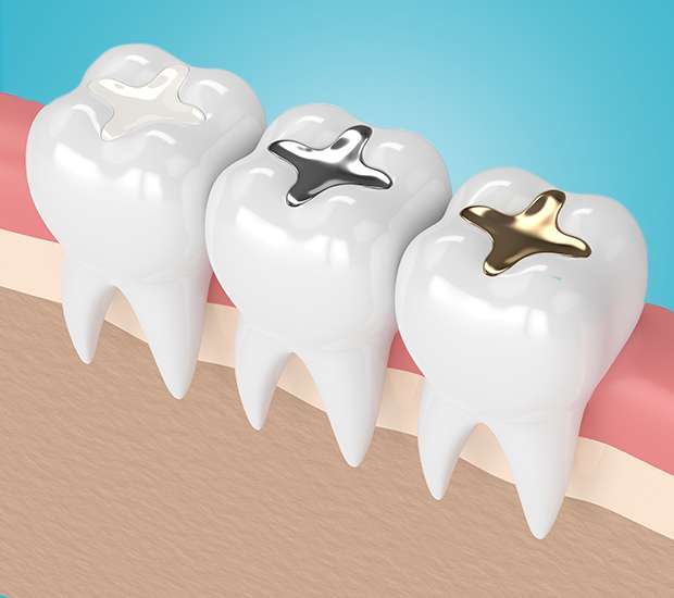 Irvine Composite Fillings