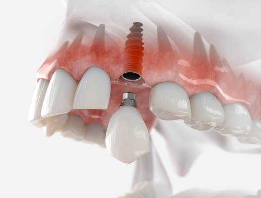 Dental Implant Irvine, CA