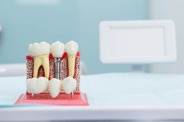 Can You Get Dental Implants For More Than One Missing Tooth?