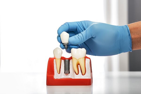 Why Dental Implants Are Comfortable And Secure