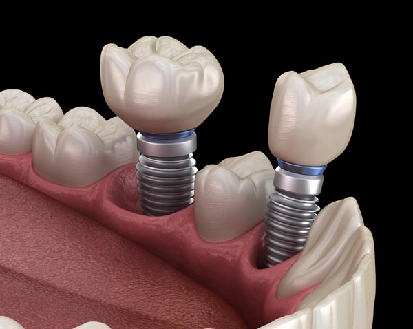 Dental Implants: Replace Your Missing Teeth - Light Breeze Dental Irvine California