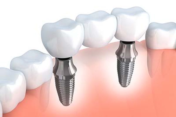 Mini Dental Implants