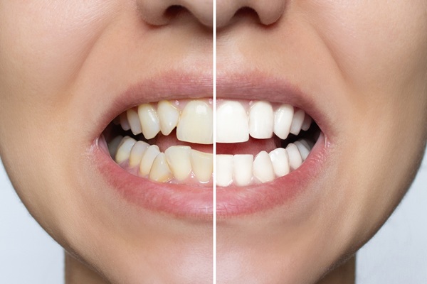 Professional Teeth Whitening: In Office Vs  At Home Options