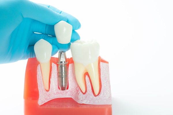 Is It Painful To Get A Tooth Implant?