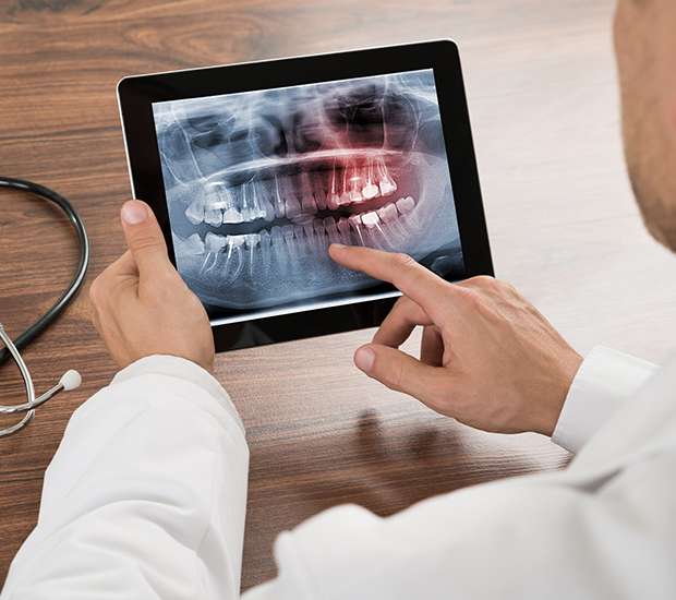 Irvine Types of Dental Root Fractures