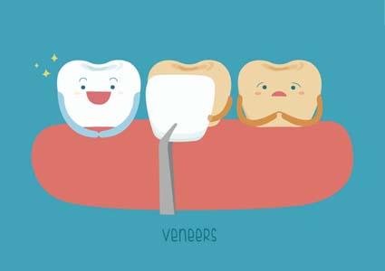 Dental Veneers