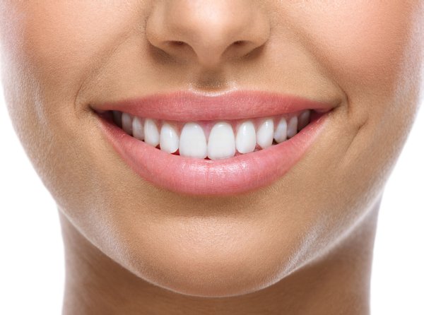 Veneers Dentist in Irvine